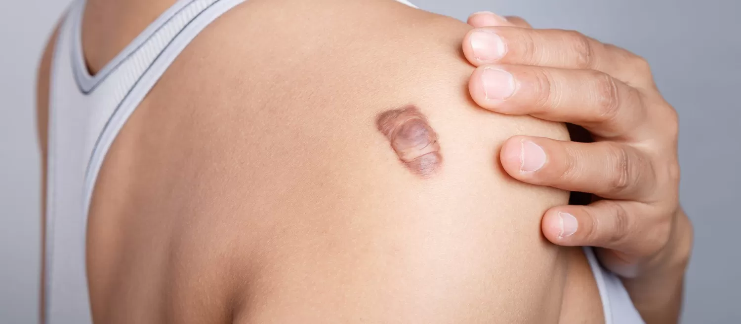 Keloid Yara Lezyonları Nedir?